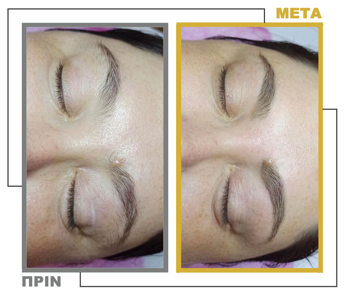 Νυφικό_Μακιγιάζ_Μεσοθεραπεία_nifiko_makigiaz_mesotherapia_20230125_155528