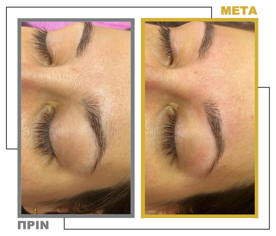 Νυφικό_Μακιγιάζ_Μεσοθεραπεία_nifiko_makigiaz_mesotherapia_20230125_155541