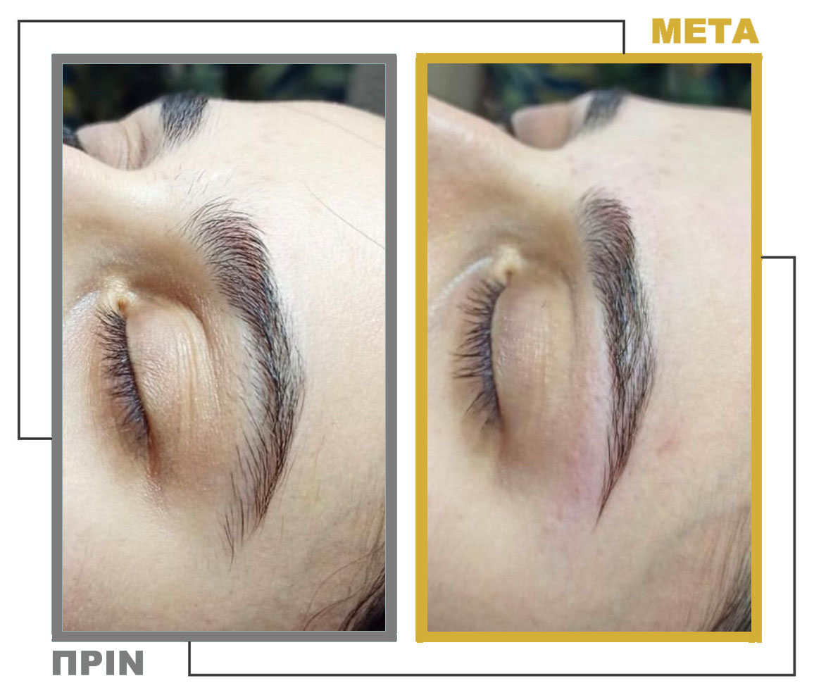 Νυφικό_Μακιγιάζ_Μεσοθεραπεία_nifiko_makigiaz_mesotherapia_20230125_155611