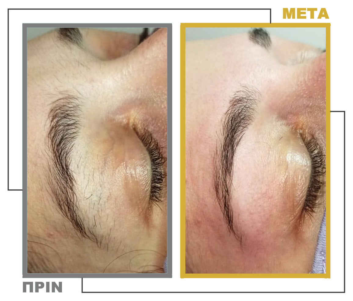 Νυφικό_Μακιγιάζ_Μεσοθεραπεία_nifiko_makigiaz_mesotherapia_20230125_155632