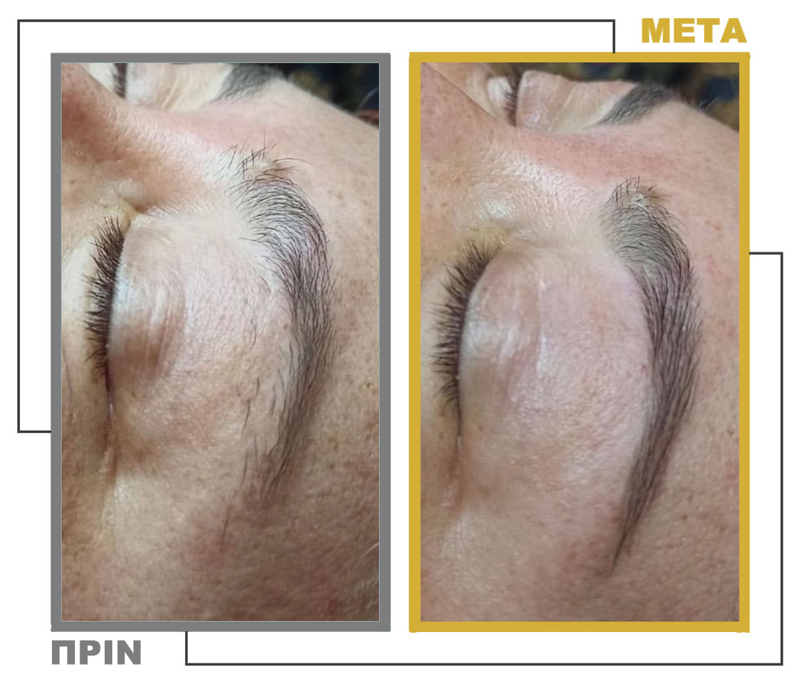 Νυφικό_Μακιγιάζ_Μεσοθεραπεία_nifiko_makigiaz_mesotherapia_20230125_155643