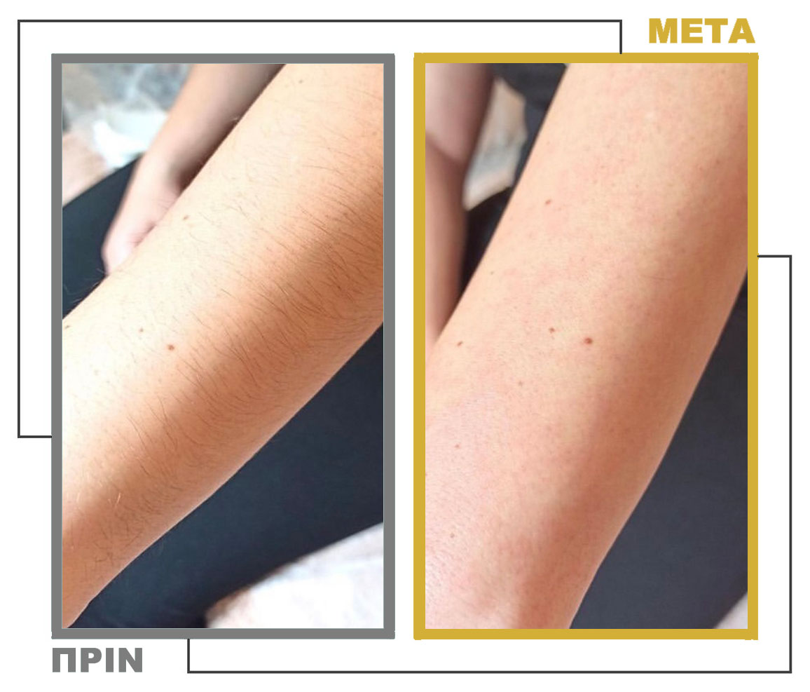 Νυφικό_Μακιγιάζ_Μεσοθεραπεία_nifiko_makigiaz_mesotherapia_20230302_164911