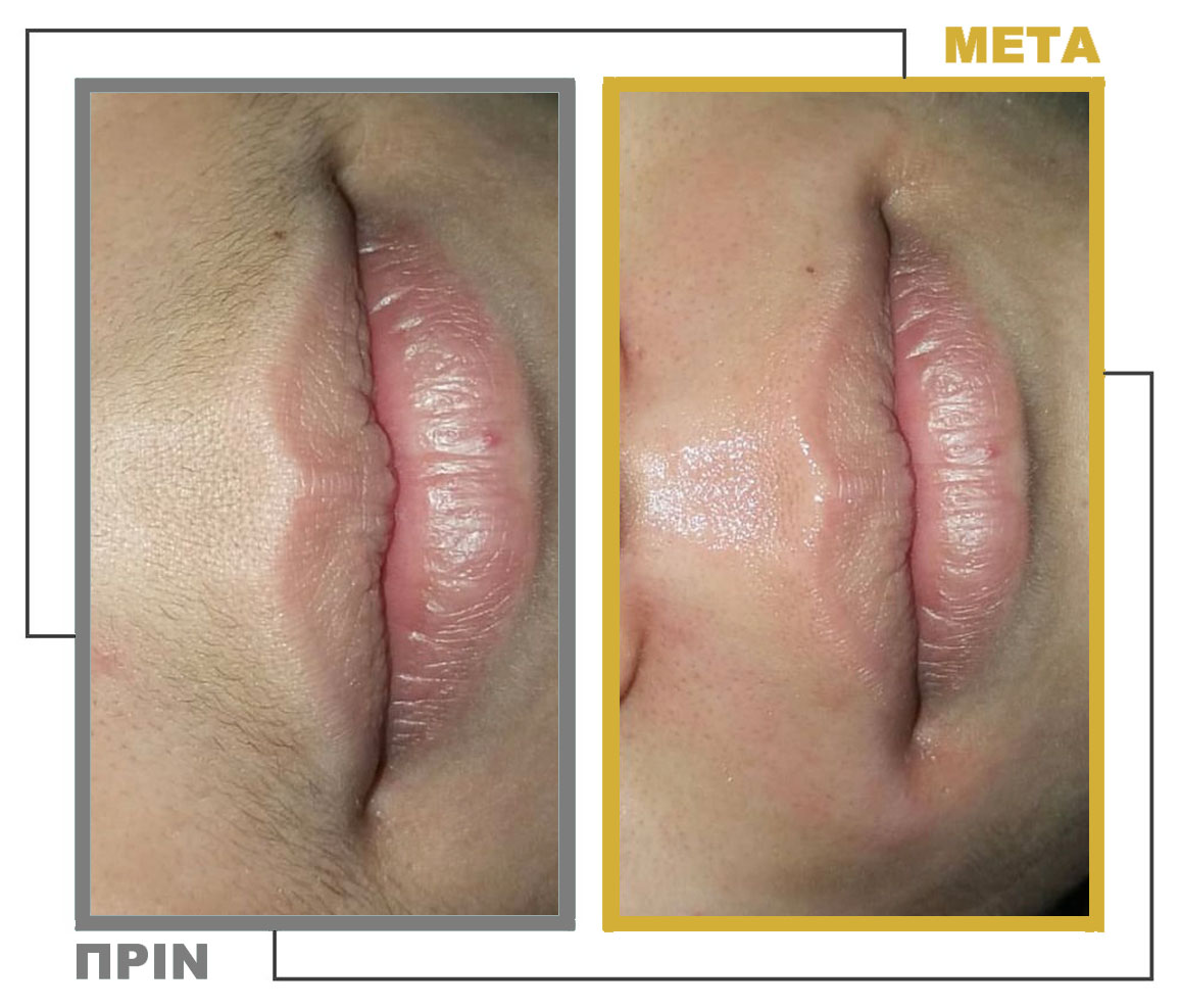 Νυφικό_Μακιγιάζ_Μεσοθεραπεία_nifiko_makigiaz_mesotherapia_20230302_164926